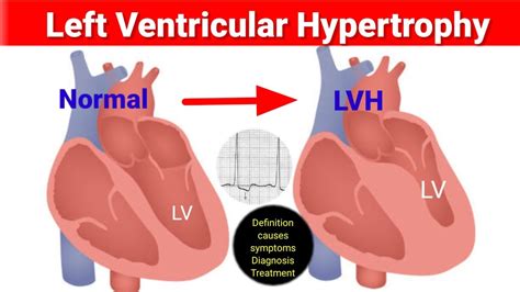 lv hypertrophy meaning|fixing lvh without medication.